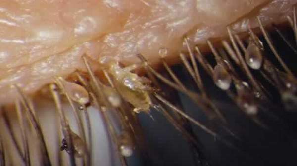 pubic lice symptoms