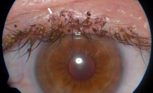 pubic lice on a eyelashes in children